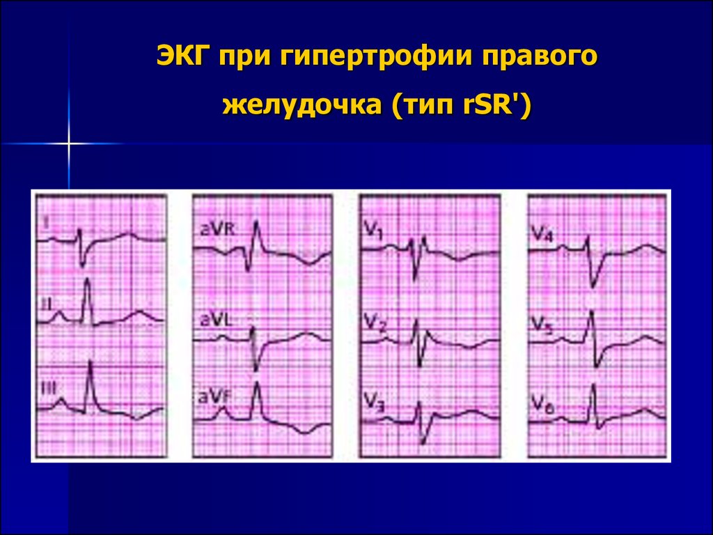 Гипертрофия левого предсердия левого желудочка. ОИМ правого желудочка на ЭКГ. Инфаркт миокарда правого желудочка на ЭКГ. ЭКГ критерии инфаркта правого желудочка. Инфаркт пж ЭКГ.