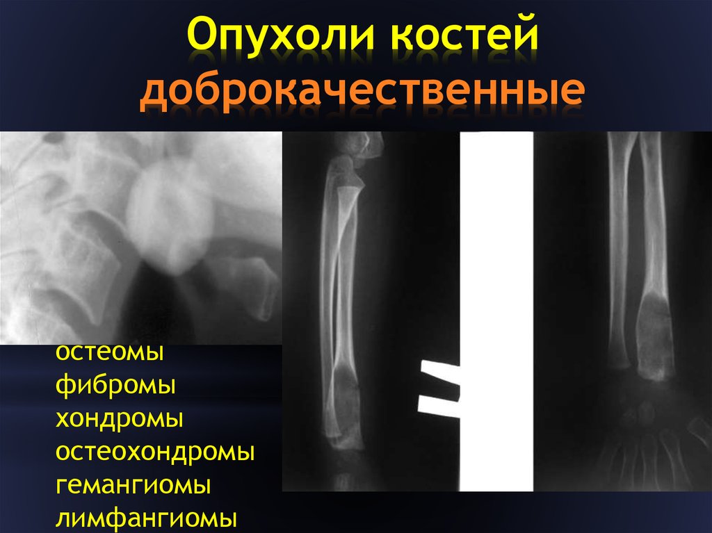 Доброкачественные опухоли костей презентация