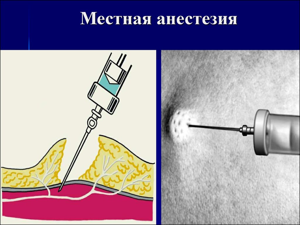 Анестезия на латинском