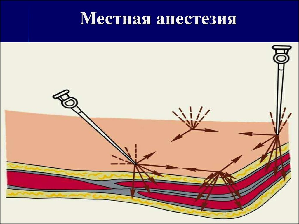 Анестезия по брауну