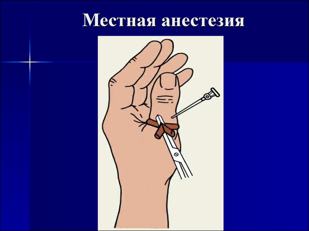 Что такое анестезия. Местная анестезия местного обезболивания. Местная анестезия презентация. Местное обезболивание рисунок.