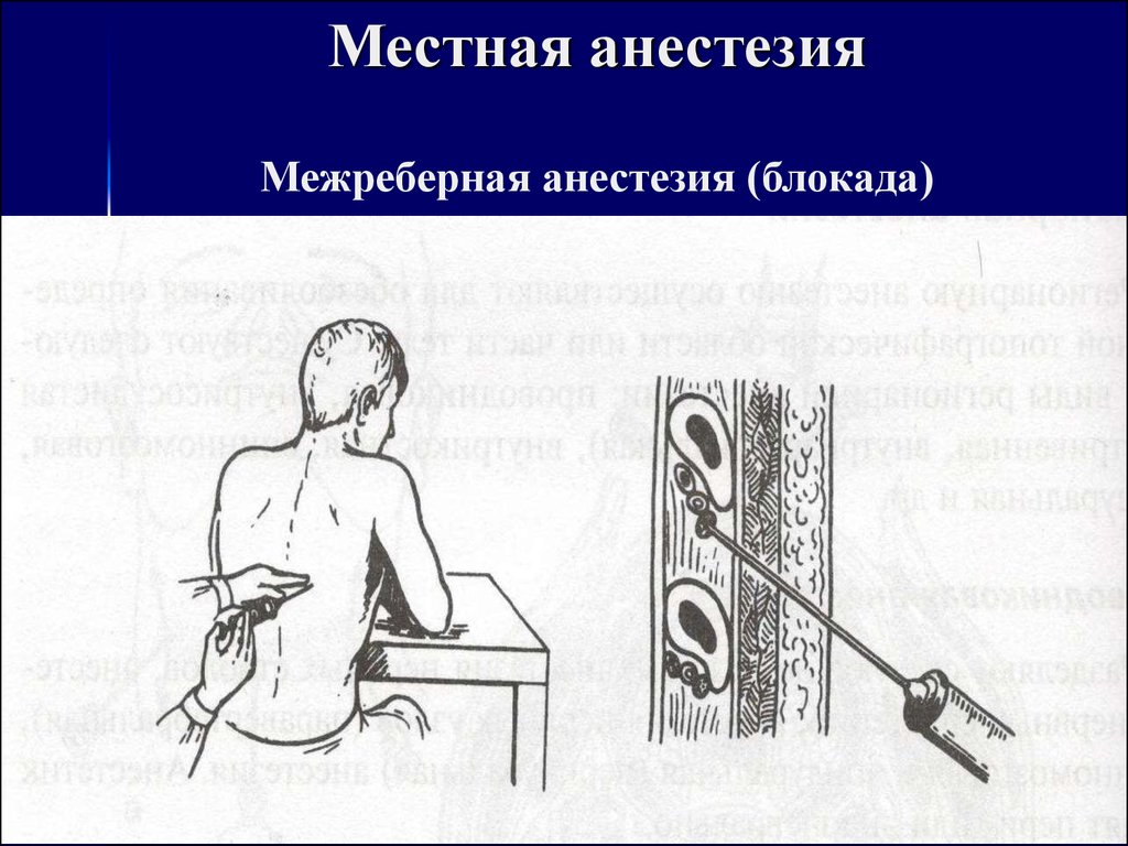 Что такое местная анестезия при операции. Обезболивание местной анестезии. Межреберная анестезия проводниковая. Местная анестезия презентация.