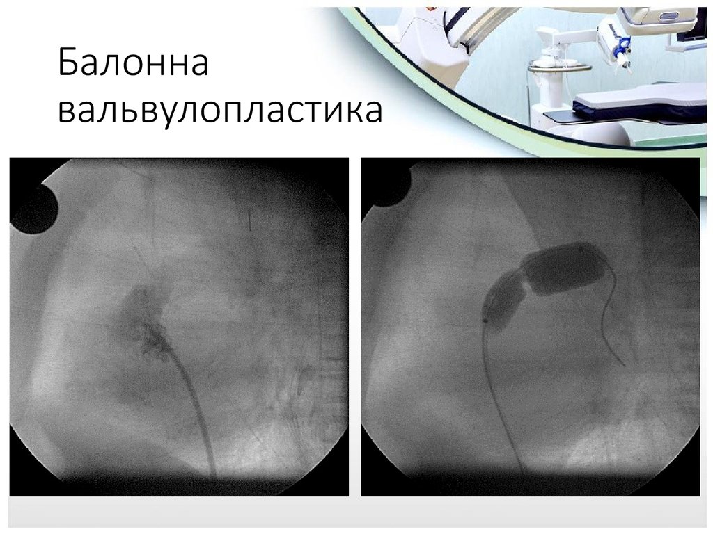 Баллонная вальвулопластика митрального клапана