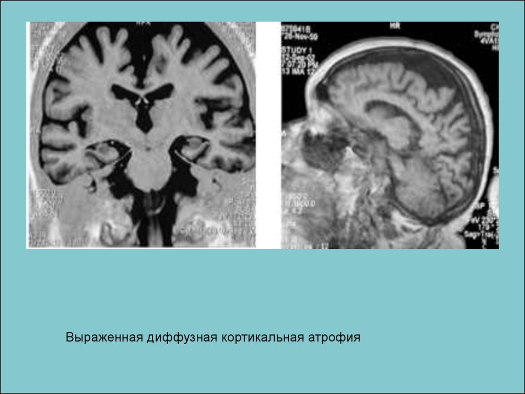 Атрофия головного мозга продолжительность. Диффузная атрофия мозга кт. Атрофические изменения головного мозга кт. Кортикальная церебральная атрофия 2-3 ст.