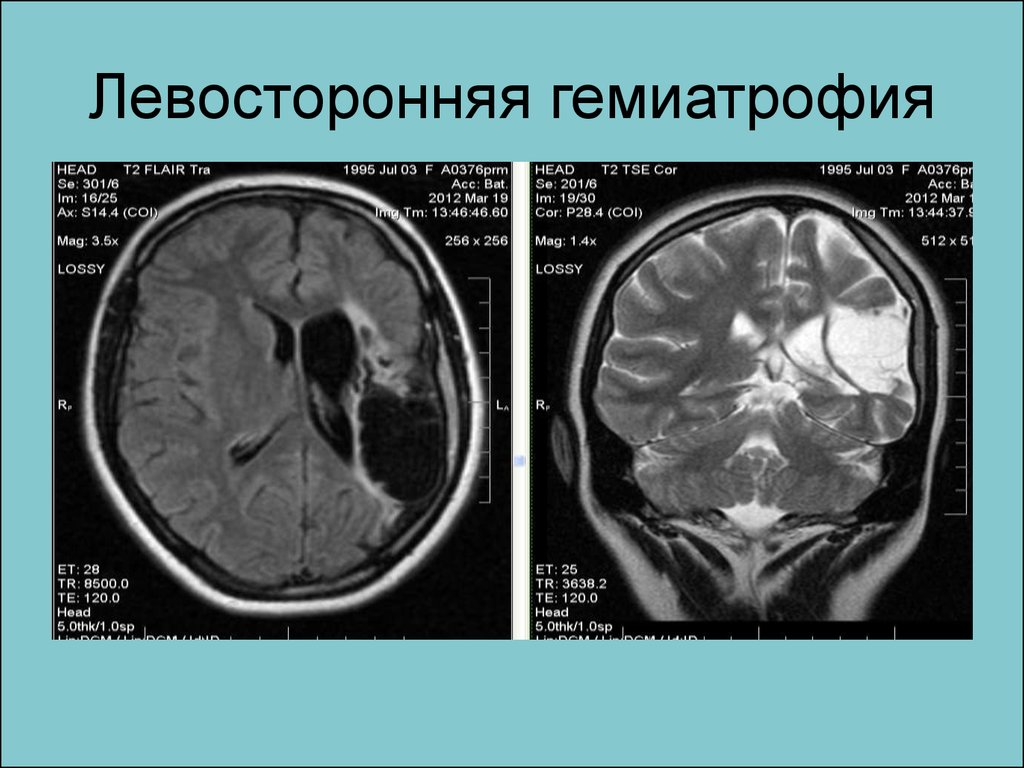 Атрофия головного мозга продолжительность. Левосторонняя гемиатрофия. Церебральная гемиатрофия. Прогрессирующая гемиатрофия лица Парри-ромберга.