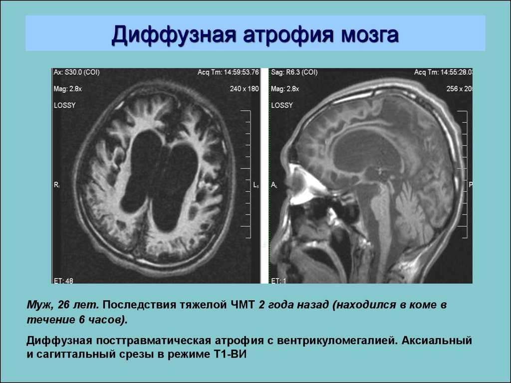 Корковые изменения головного мозга. Атрофические изменения головного мозга кт. Кт признаки атрофия мозга. Атрофические изменения головного мозга мрт. Атрофия головного мозга 2ст.
