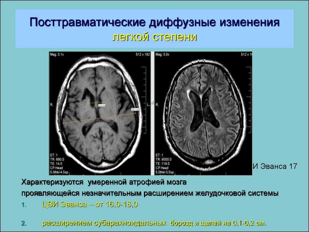 Умеренные диффузные нарушения. Атрофические изменения головного мозга кт. Диффузные изменения головного мозга. Диффузные изменения головного мозга на мрт.