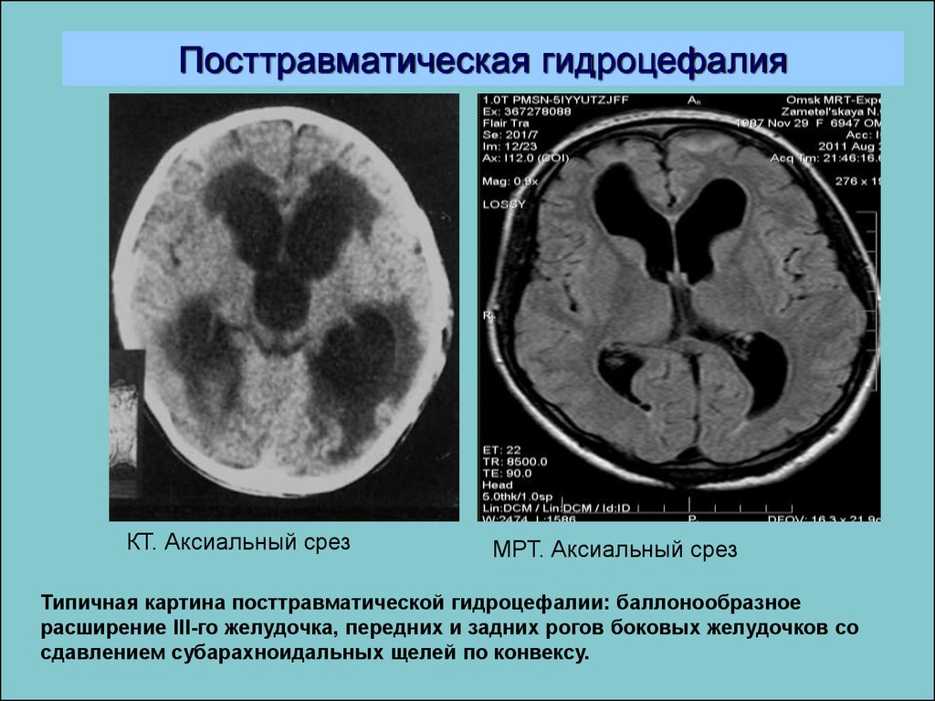 Атрофия головного мозга степени. Гидроцефалия головного мозга на кт. Окклюзионная гидроцефалия кт. Наружная гидроцефалия головного мозга кт. Посттравматическая гидроцефалия мрт.