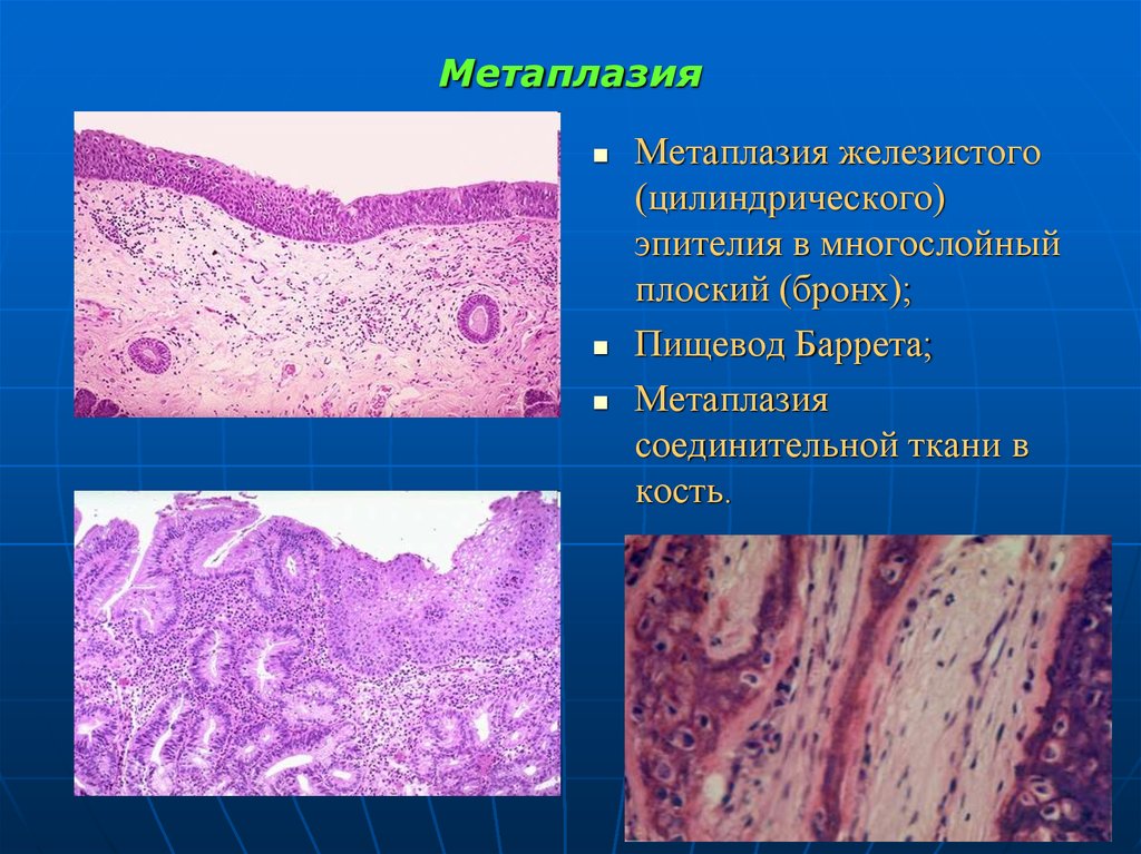 Плоскоклеточная эндометрия. Метаплазия многослойного плоского эпителия микропрепарат. Кишечная метаплазия патанатомия. Сквамозная метаплазия эпителия. Метаплазия эпителия гистология.