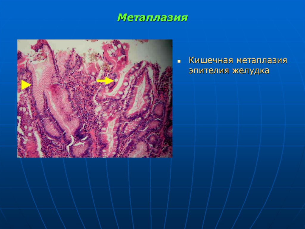 Полная метаплазия желудка