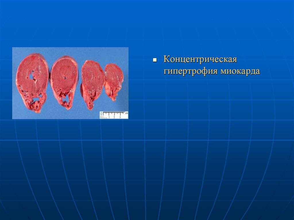 Гипертрофия миокарда. Концентрическая и эксцентрическая гипертрофия. Концентрическая и эксцентрическая гипертрофия миокарда. Эксцентрическая гипертрофия. Концентрическая гипертрофия миокарда левого.