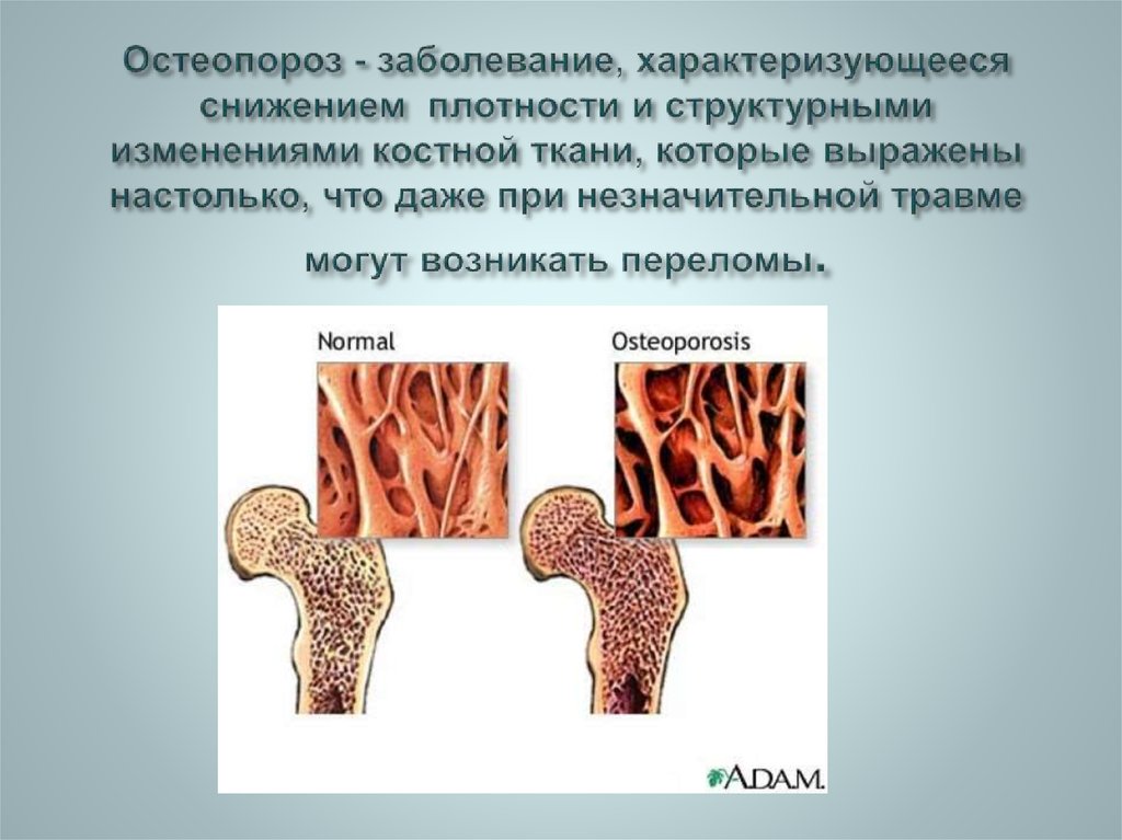 Остеопороз народное. Остеопороз наследственное заболевание. Изменение костной ткани. Заболевания костной ткани. Костная ткань остеопороз.