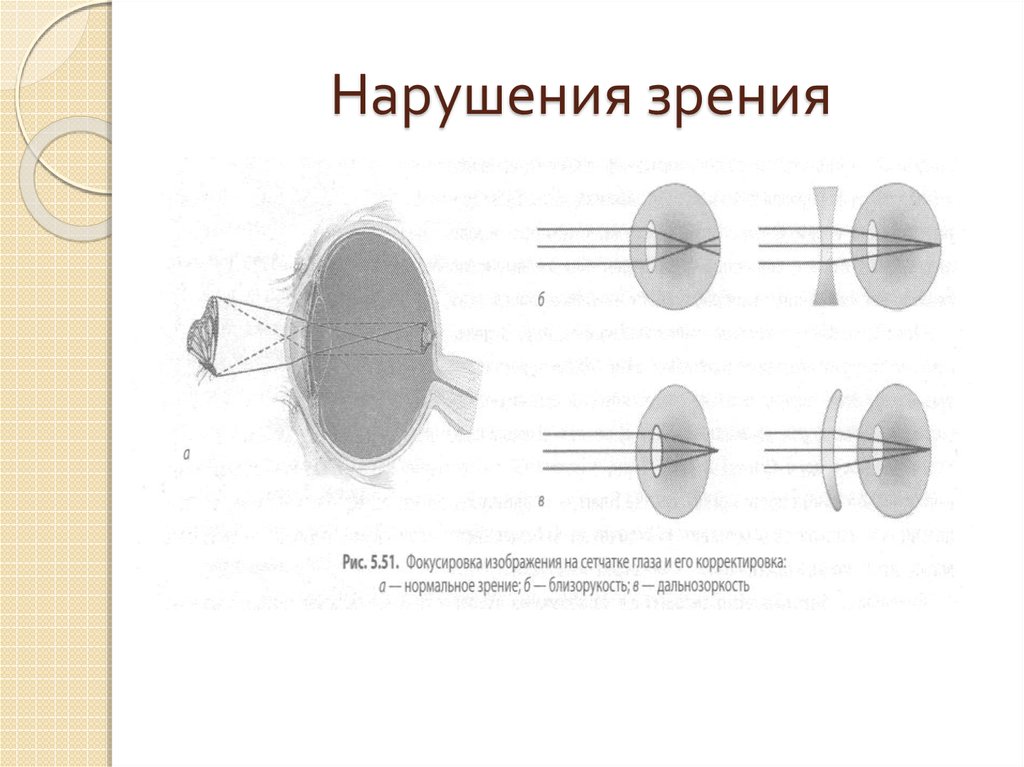 Какие дефекты зрения изображены на рисунках предложите дорисуйте способы их исправления