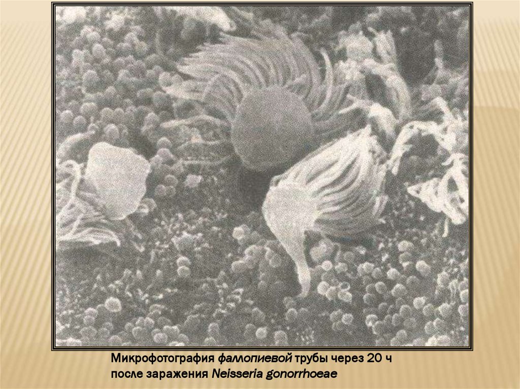 Гонорея - презентация онлайн