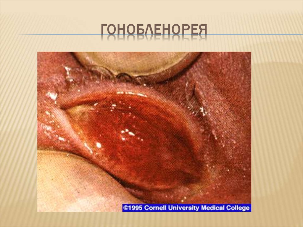 Гонобленорея