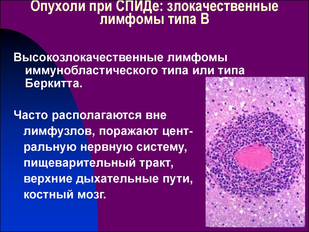 Опухоли при СПИДе: злокачественные лимфомы типа В