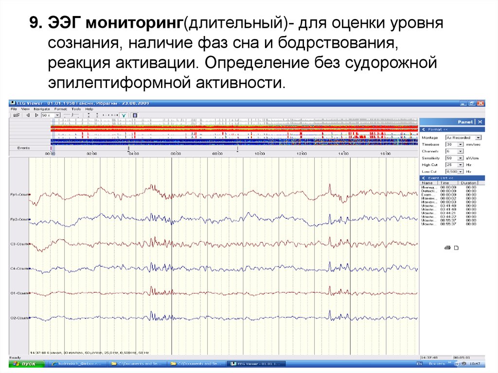 Ээг мониторинг сна. ЭЭГ мониторинга показатели. Реакция активации ЭЭГ. Реакция активации головного мозга на ЭЭГ. Отсутствие реакции активации ЭЭГ.