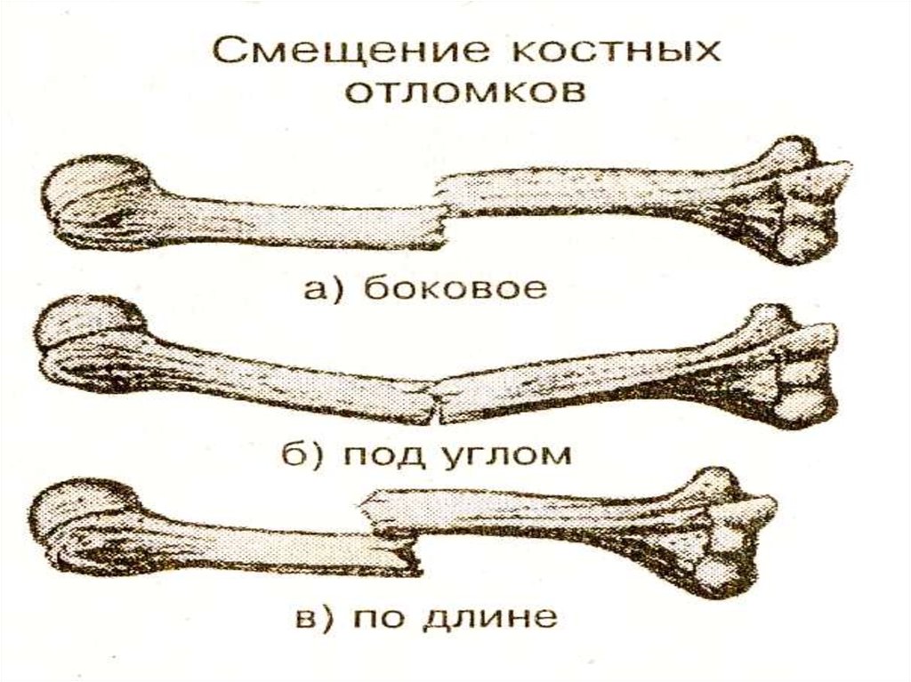 Смещение отломков кости. Смещение костных отломков по ширине. Типы смещения отломков при переломах. Классификация смещений костных отломков. Смещение костных отломков по длине и ширине.