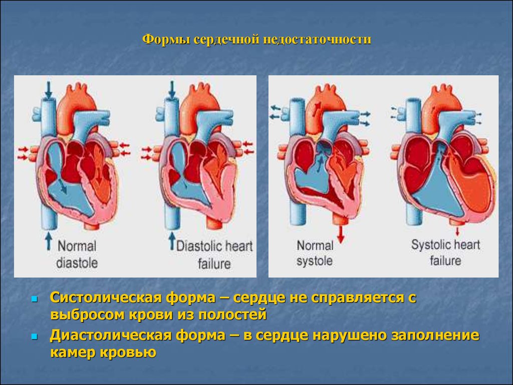 Частая причина сердечной недостаточности. ХСН по сердечному циклу. Сердечная недостаточн. Сесердечная недостаточность это. Острой сердечной недостаточности.