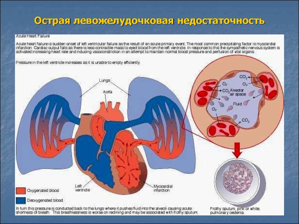 Картина острой левожелудочковой недостаточности