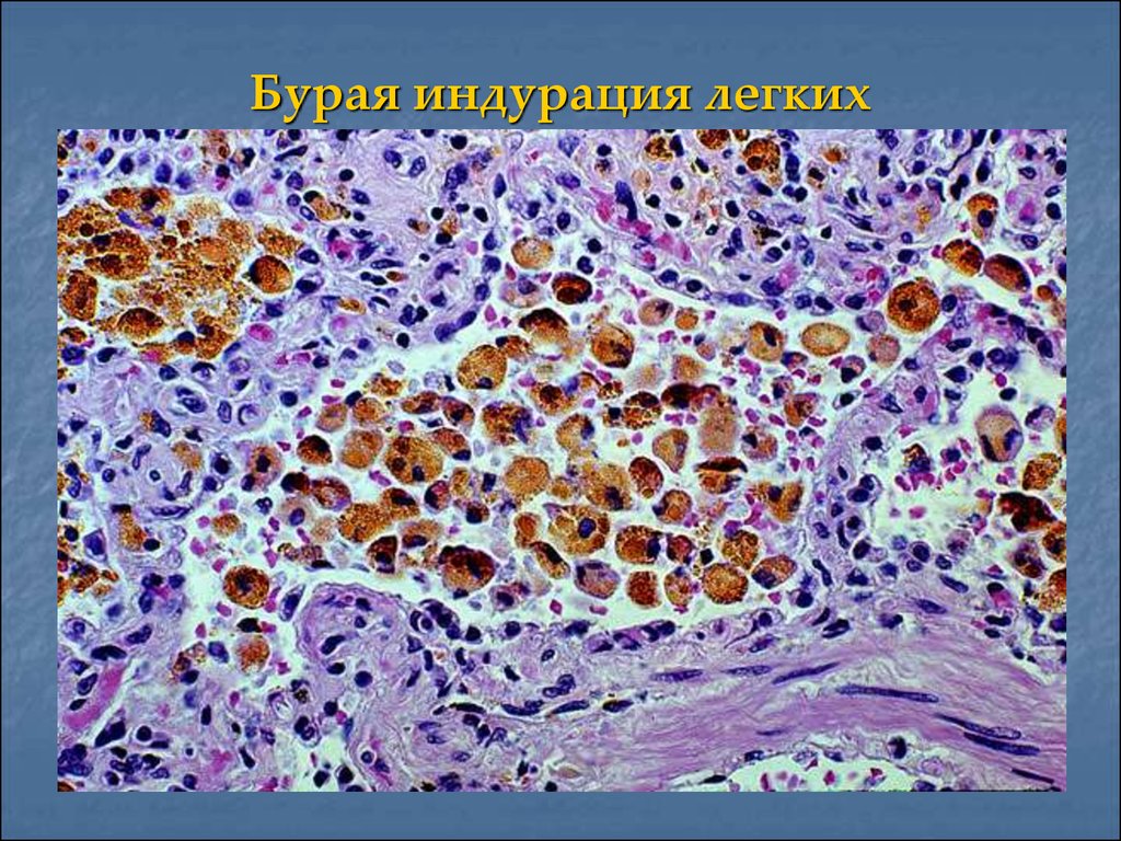 Бурая индурация легких это. Бурая индурация легкого микропрепарат. Препарат бурая индурация легких Патан. Бурое уплотнение легких. Макропрепарат бурая индурация л.