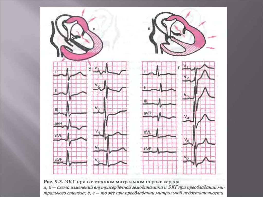Экг при пролапсе митрального клапана фото
