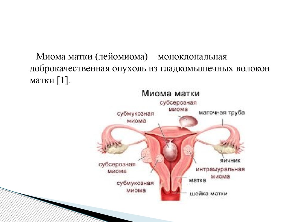 Интрамуральная миома матки что это