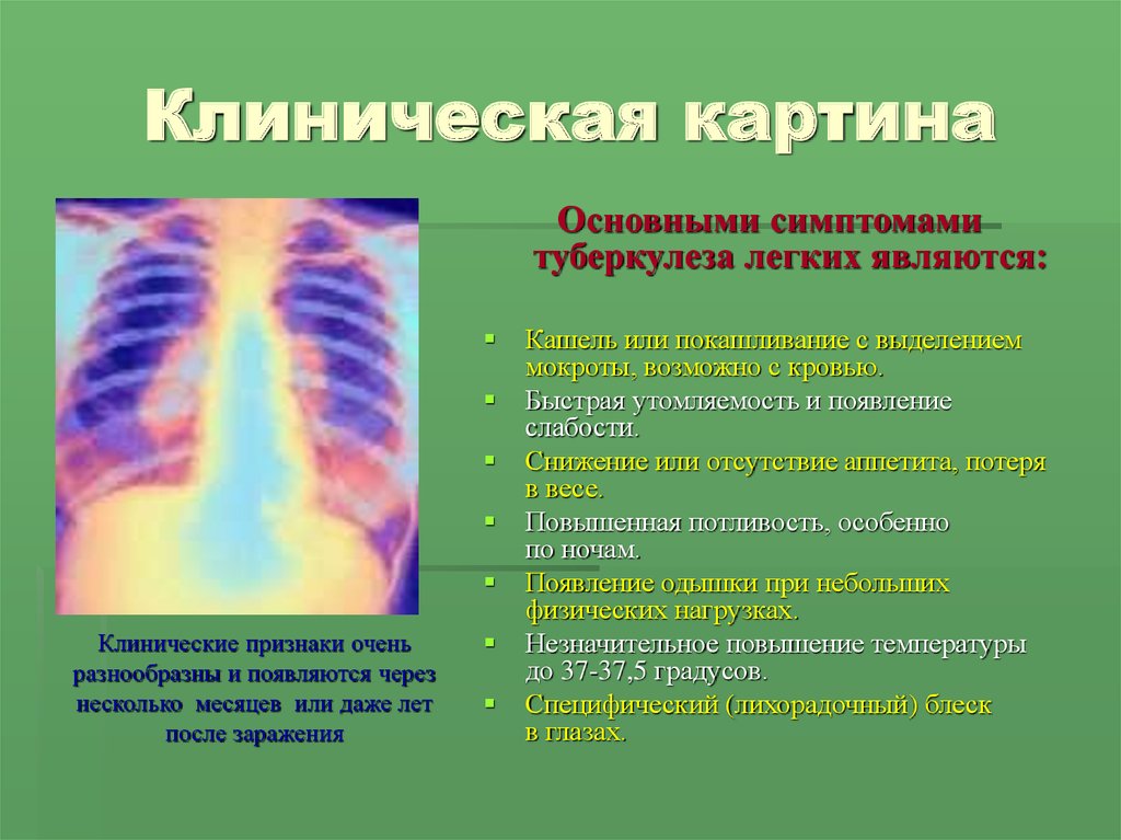 Начальная стадия туберкулеза у взрослых. Клиническая картина туберкулёза лёгких. Клинические проявления туберкулёза лёгких. Туберкулёз лёгких у взрослых. Клиническая картина туберкулеза легких у взрослых.