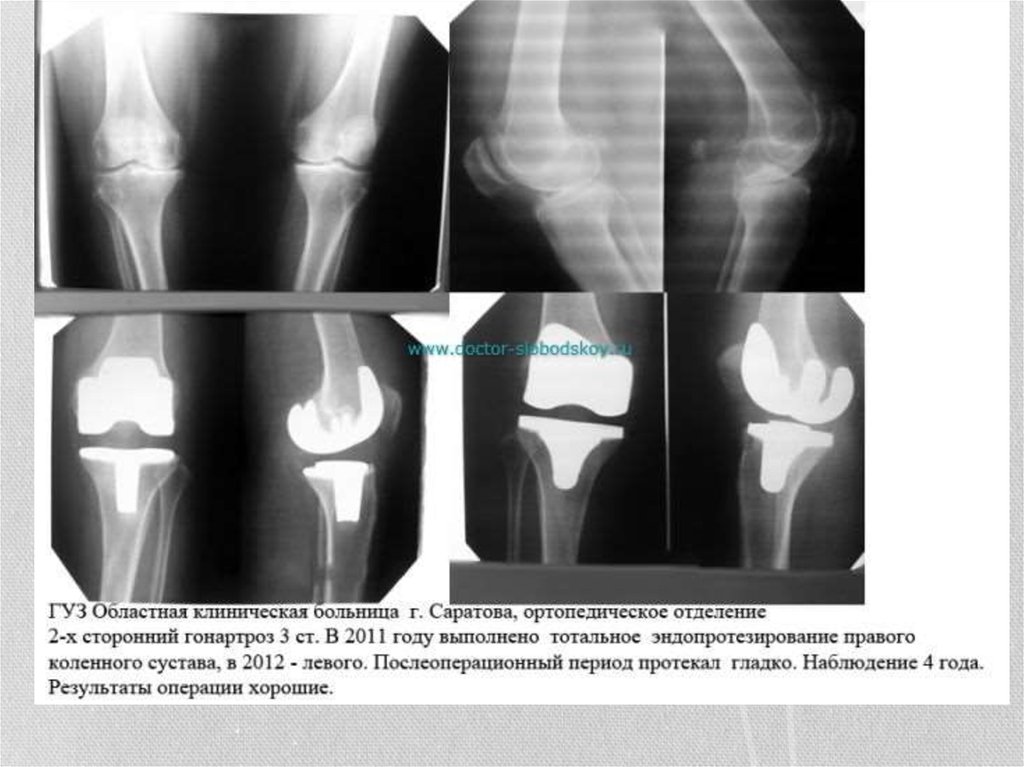 Замена сустава при коксартрозе. Гонартроз эндопротезирование коленного сустава. Коксартроз коленного сустава рентген. Коксартроз рентгенограмма коленного.