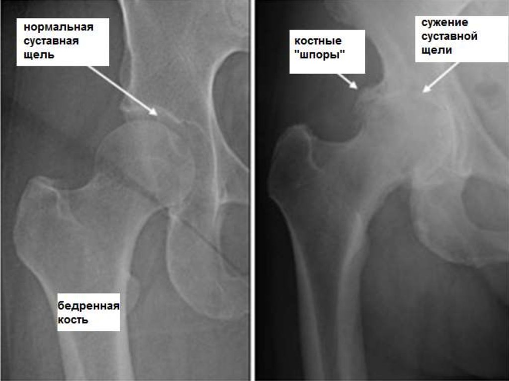 2 степень тазобедренных суставов. Степени коксартроза тазобедренного сустава рентген. Рентген коксартроза тазобедренного сустава 1 степени. Рентгеновский снимок тазобедренного сустава при коксартрозе. Коксартроз тазобедренного сустава рентген.