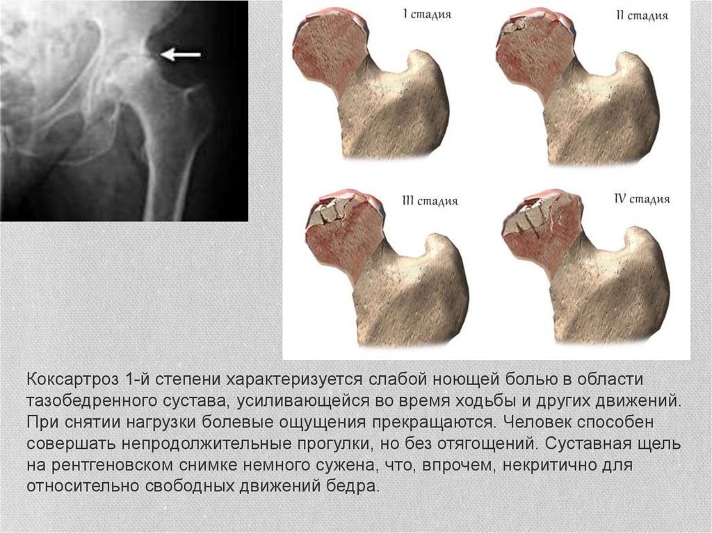 Коксартроз тазобедренного сустава 1 2 степени. Стадии артроза тазобедренного сустава на кт. Коксартроз 1 степени тазобедренного рентген. Коксартроз 1 стадии рентген. 4 Стадия артроза тазобедренного сустава.