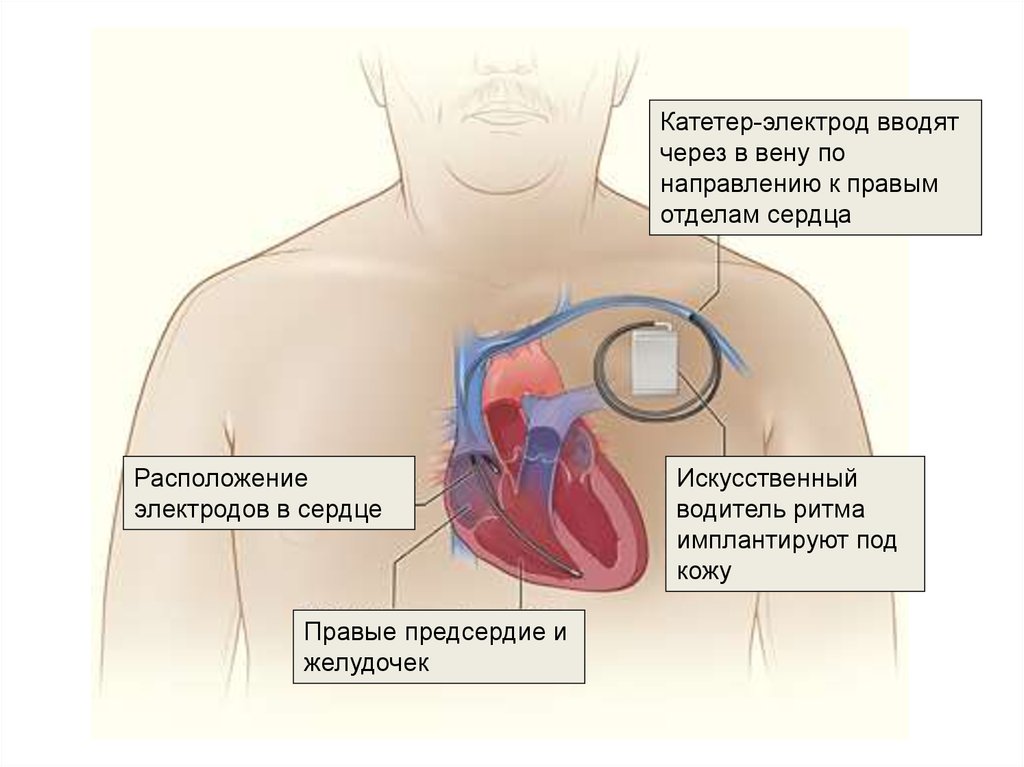 Инвалидность при стентировании. Электроды кардиостимулятора. Кардиостимулятор сердца электроды. Электроды после операции на сердце. Что такое кардиостимулятор группа инвалидности.