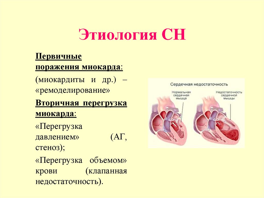 Кардиомиопатия предсердий. Миокардит этиология. Миокардит и кардиомиопатия отличия.