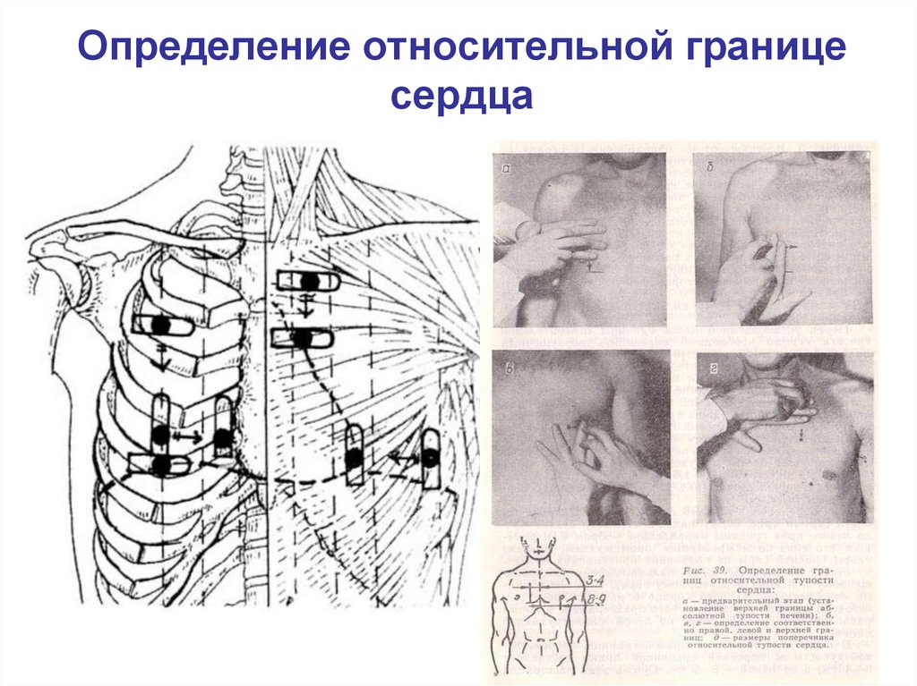 Определение границ сердечной тупости. Перкуссия сердца границы относительной сердечной тупости. Пропедевтика границы относительной тупости сердца. Методика определения границ относительной сердечной тупости. Перкуссия границ сердца у детей.