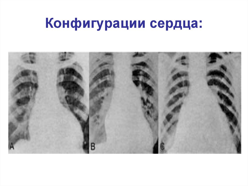 Патологические формы грудной клетки. Патологические конфигурации сердца. Шаровидная конфигурация сердца. Конфигурации сердца пропедевтика. Патологические конфигурации сердца шаровидная.