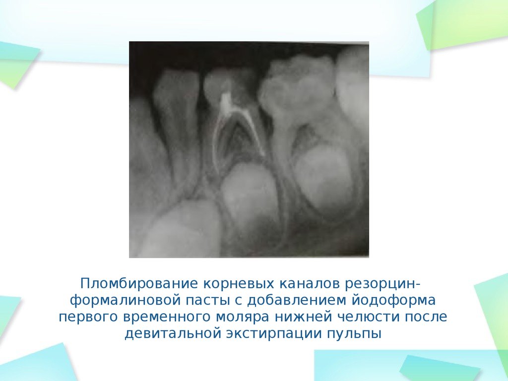 Эндодонтическое лечение презентация