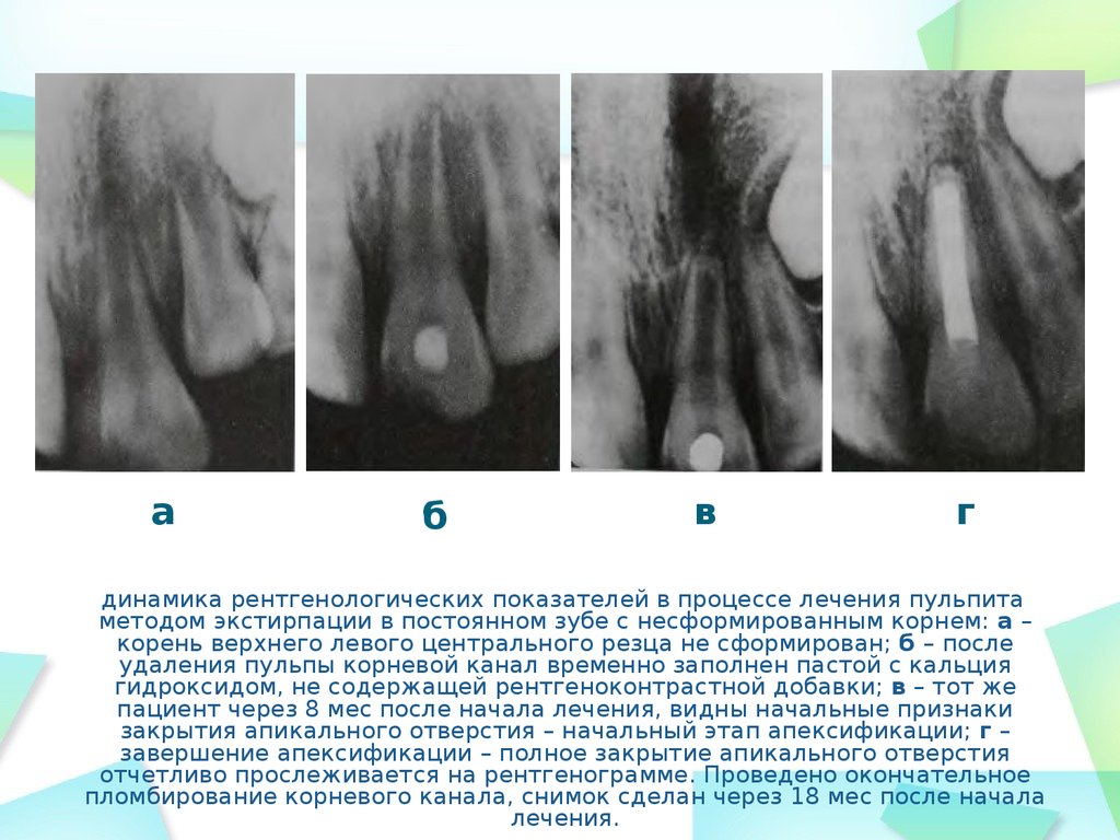 Лечение хронического периодонтита постоянных зубов со сформированными и несформированными корнями