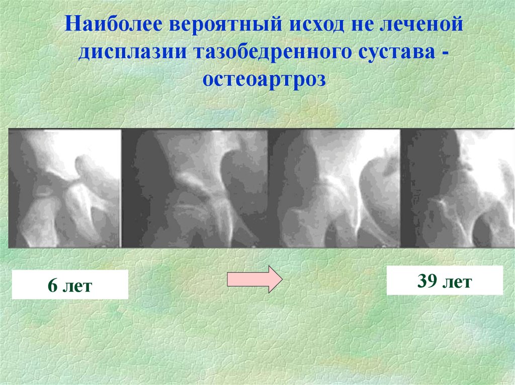 Дисплазия симптомы. Исход дисплазии тазобедренных суставов. Тазобедренные суставы дисплазия протокол рентген. Ацетабулярная дисплазия тазобедренных суставов. Критерии дисплазии тазобедренных суставов.