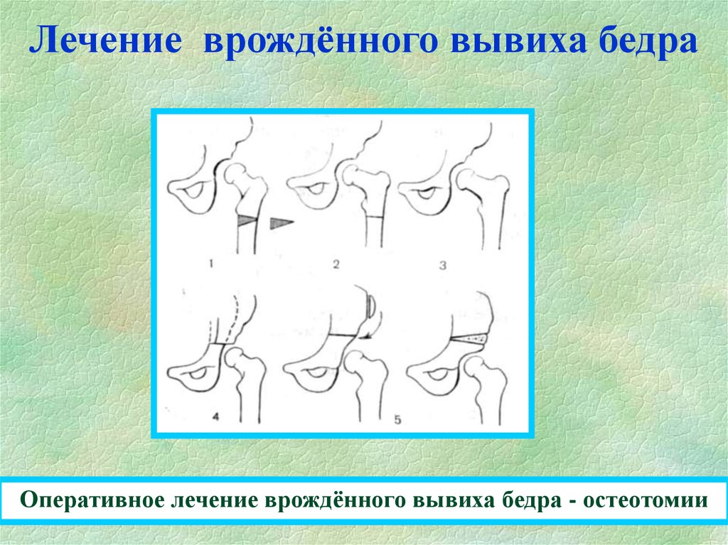 Для клинической картины врожденного вывиха бедра характерны симптомы