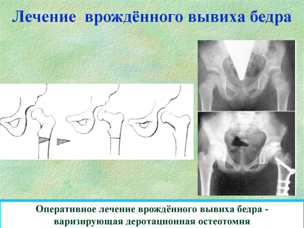 Вывих бедра. Оперативное лечение врожденного вывиха бедра. Открытое вправление вывиха бедра. Оперативные методы лечения врожденного вывиха бедра. Врожденный вывих бедра операция.