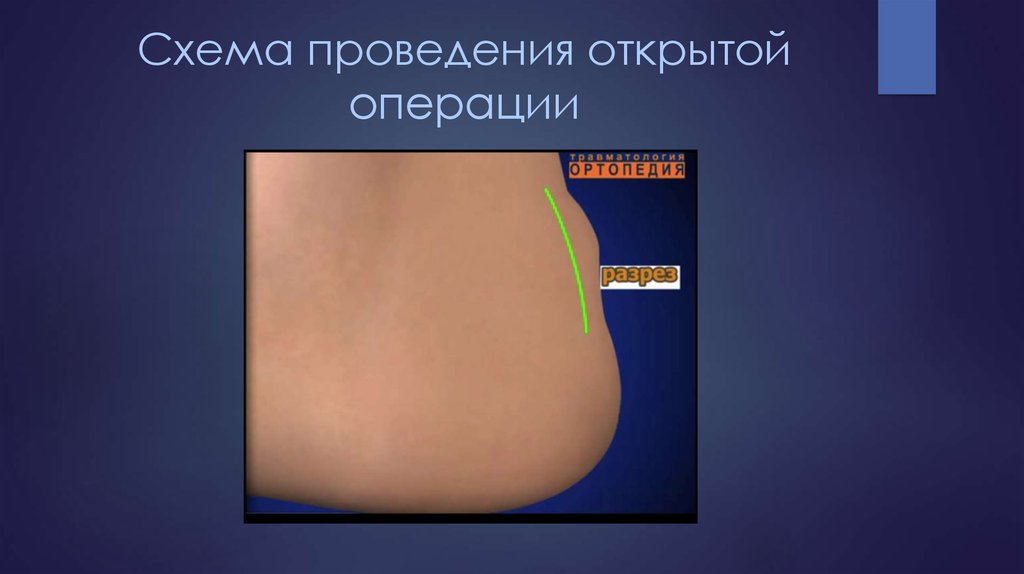 Схема проведения открытой операции