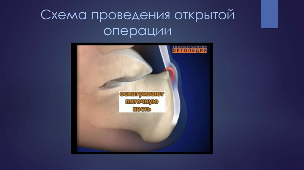 Схема проведения открытой операции