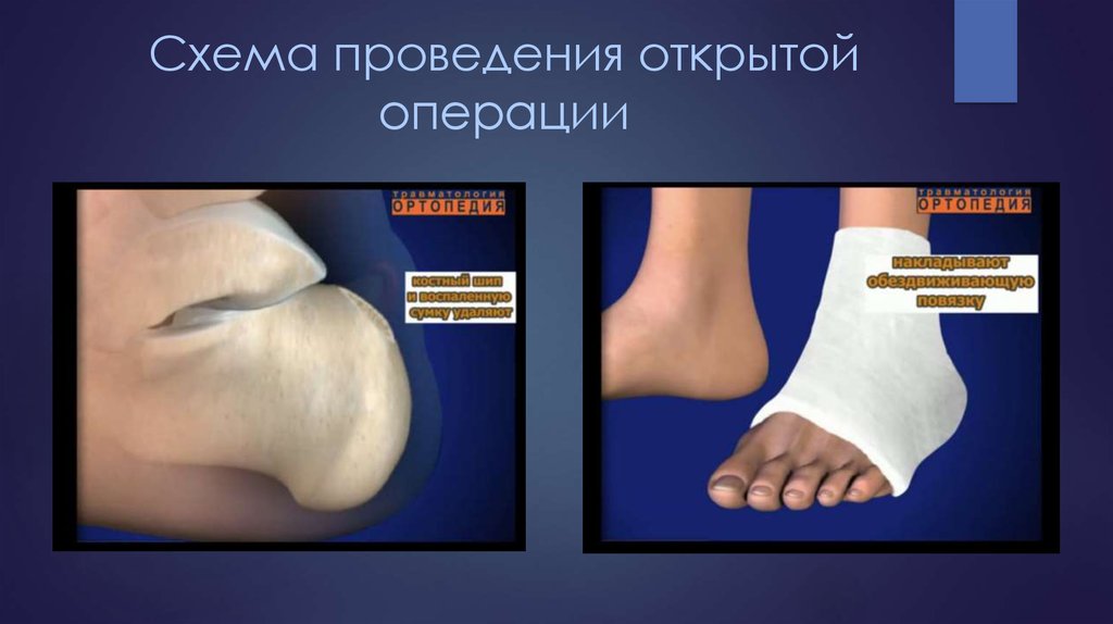 Схема проведения открытой операции