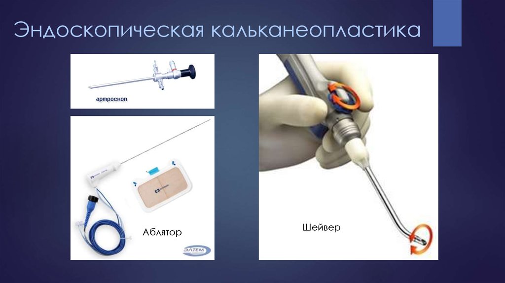 Эндоскопическая кальканеопластика