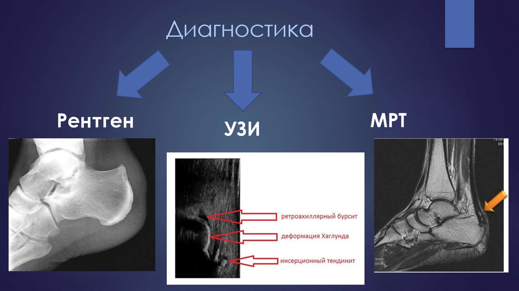 Болезнь хаглунда шинца