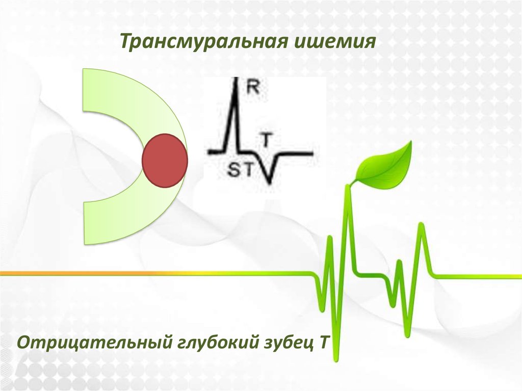 Трансмуральный инфаркт. Трансмуральная ишемия на ЭКГ.