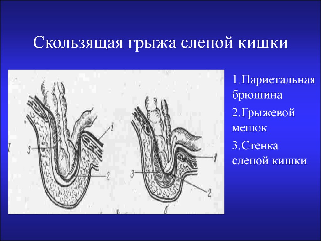 Скользящая грыжа под