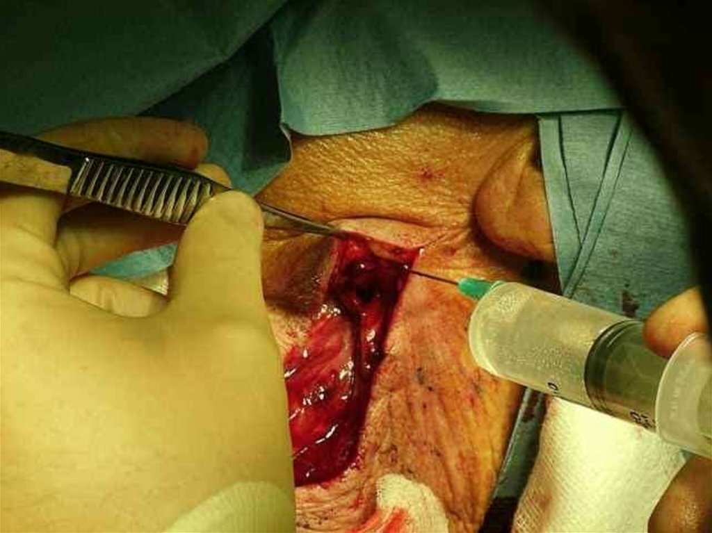 factors are 95 which of Carotid Ð¾Ð½Ð»Ð°Ð¹Ð½ Ð¿Ñ€ÐµÐ·ÐµÐ½Ñ‚Ð°Ñ†Ð¸Ñ  Endarterectomy