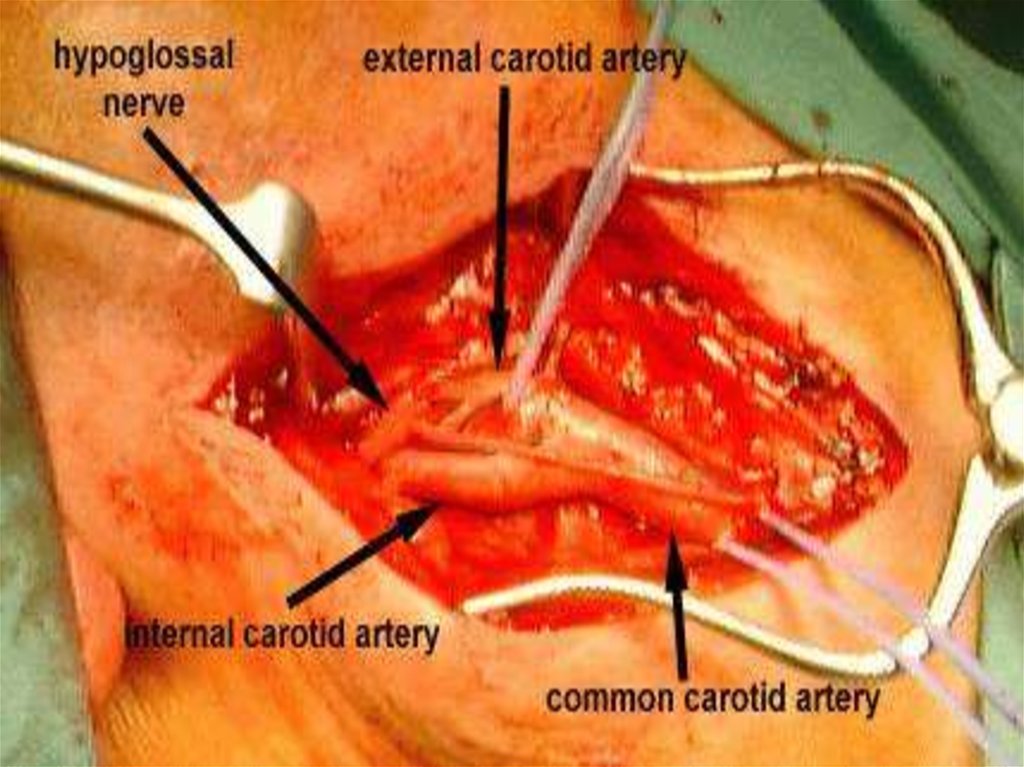 Carotid Endarterectomy - презентация онлайн
