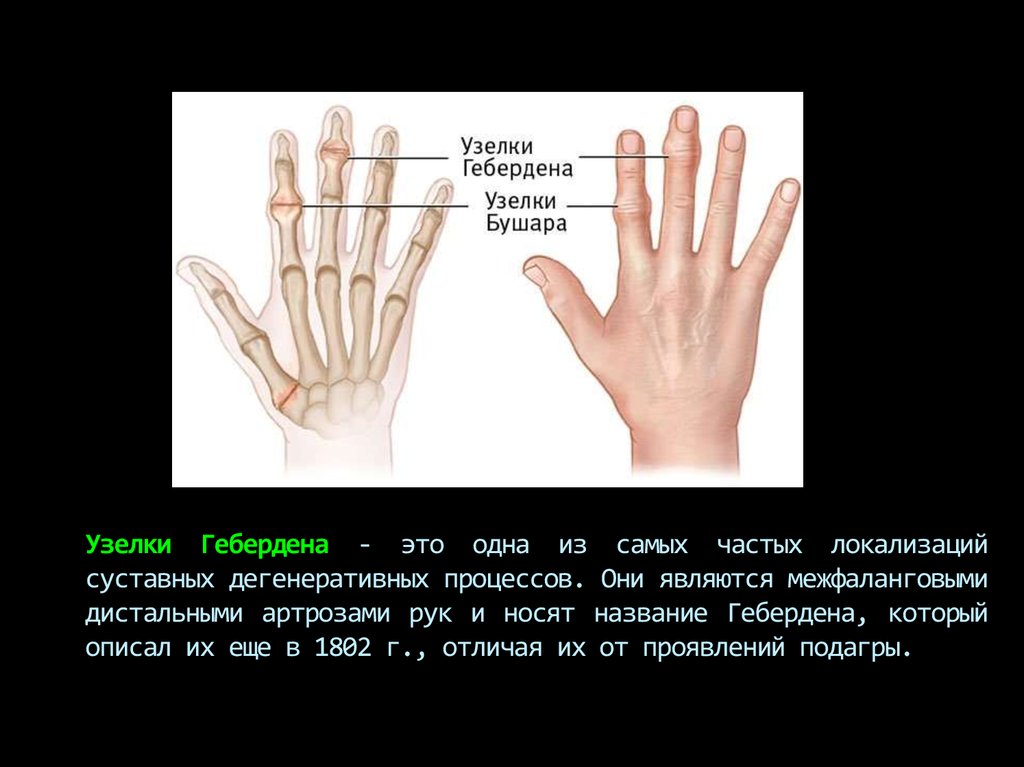 Остеоартроз межфалангового сустава кистей. Остеоартроз узлы Гебердена. Узелки Гебердена Бушара остеоартроз. Узелки Гебердена и Бушара характерны для.